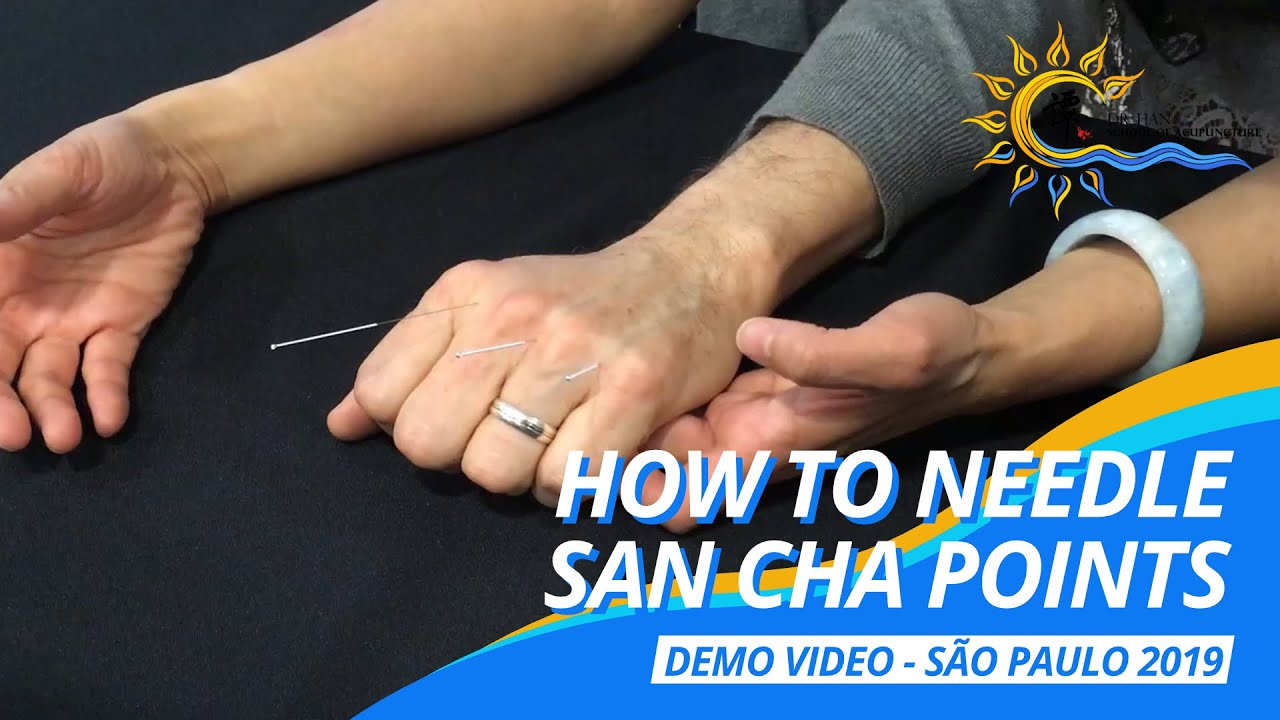 How to Needle San Cha? can treat radicular pain! 