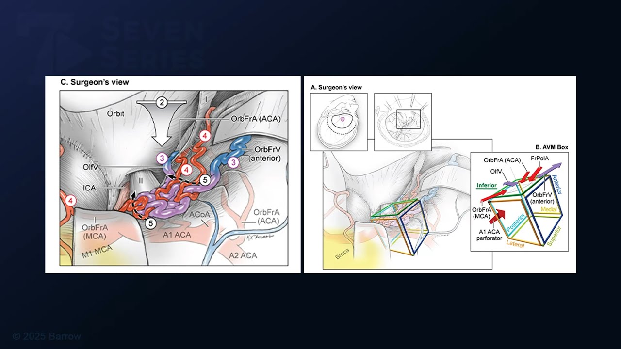 Microsurgical Resection of a Basal Frontal Arteriovenous Malformation