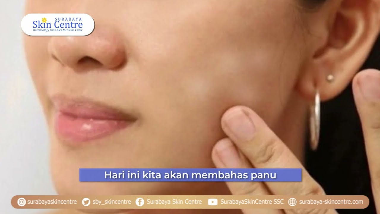 Bercak Putih di Wajah terasa Gatal?? yuk ketahui penyebabnya !!!