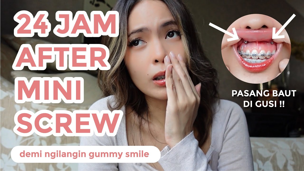 24 JAM AFTER PASANG MINI SCREW BEHEL - NGILANGIN GUMMY SMILE | Braces Journey