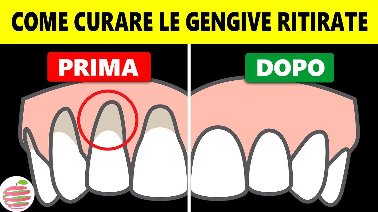 Come Trattare Le Gengive Ritirate A Casa In Modo Naturale