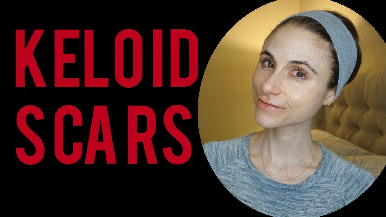 Treatments for Keloid Scars: Q&A with a dermatologist|Dr Dray