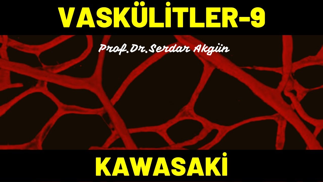 Vaskülitler, 9, Kawasaki Hastalığı, Tıp Dersleri, Romatoloji, Serdar Akgün