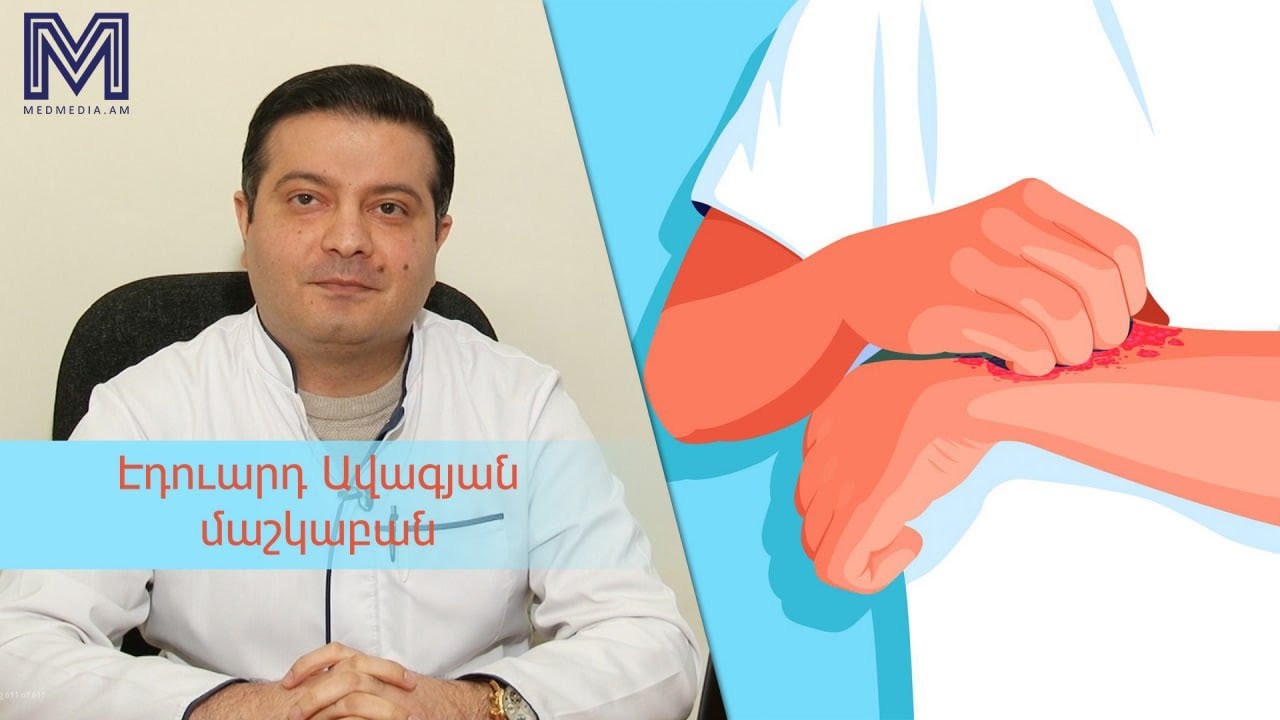 Երեք խորհուրդ բժշկից․ փսորիազ #medmedia
