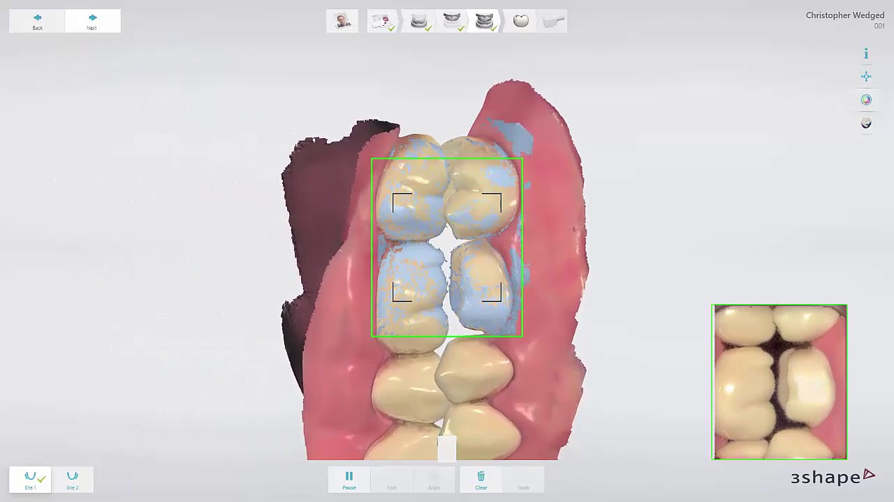 3Shape TRIOS Design Studio – réalisation d'une couronne
