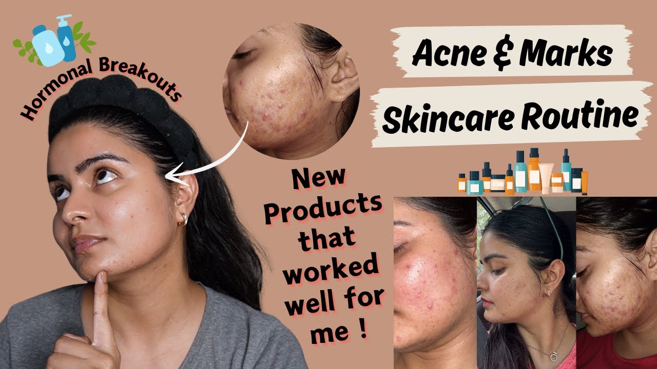 Honest Acne & Marks Skincare Routine | How I cleared my Skin? Kashika Chauhan
