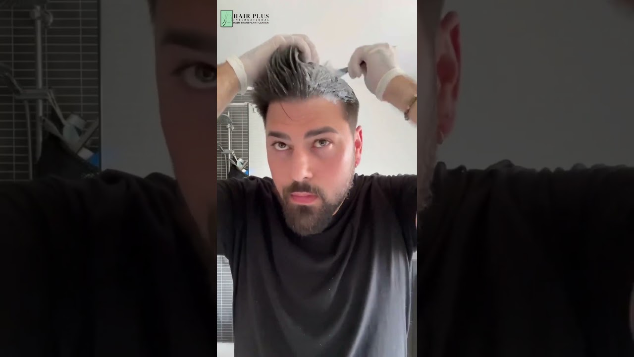 Hair Colour After Transplant &ndash; Safe or Risky?