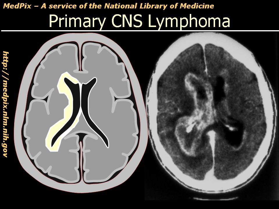 Primary CNS (Brain) Lymphoma