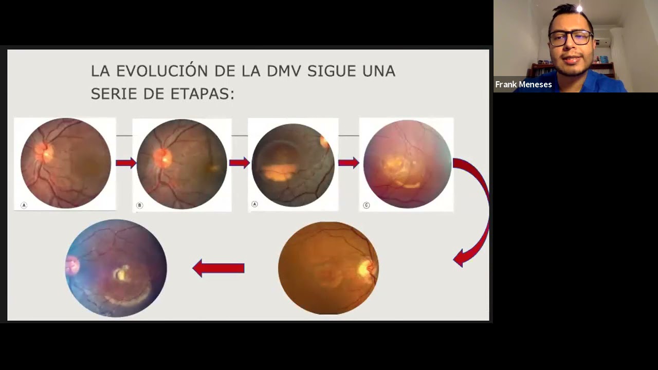 Lesiones Viteliformes Retinales Dr. Franklyn Meneses