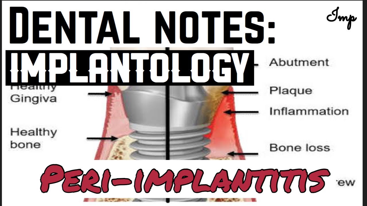 PERI-IMPLANTITIS || LATE FAILURE OF IMPLANT || IMPLANTOLOGY || made easy