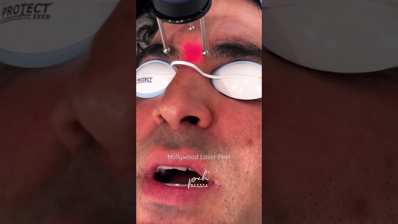 Hollywood Laser Peel, PCH MedSpa, Newport Beach, CA 