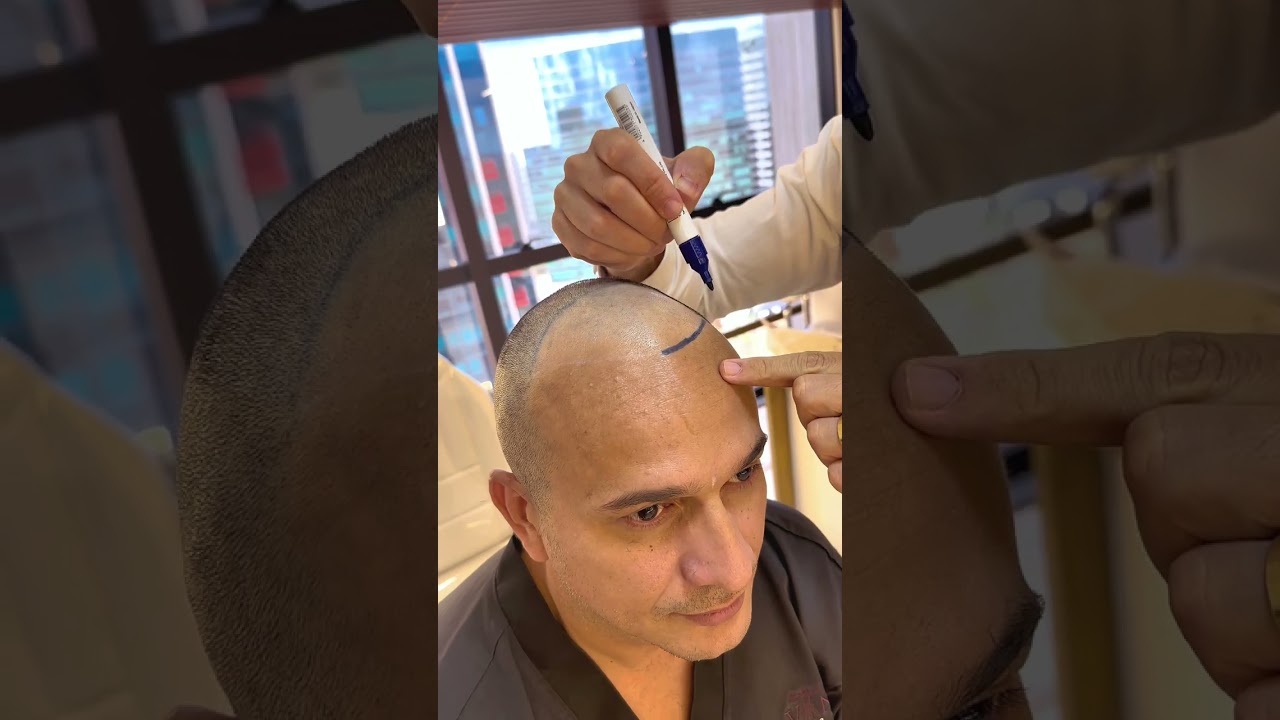 Hair transplant post-op: See the first results unfold! #vincihairclinic #shorts