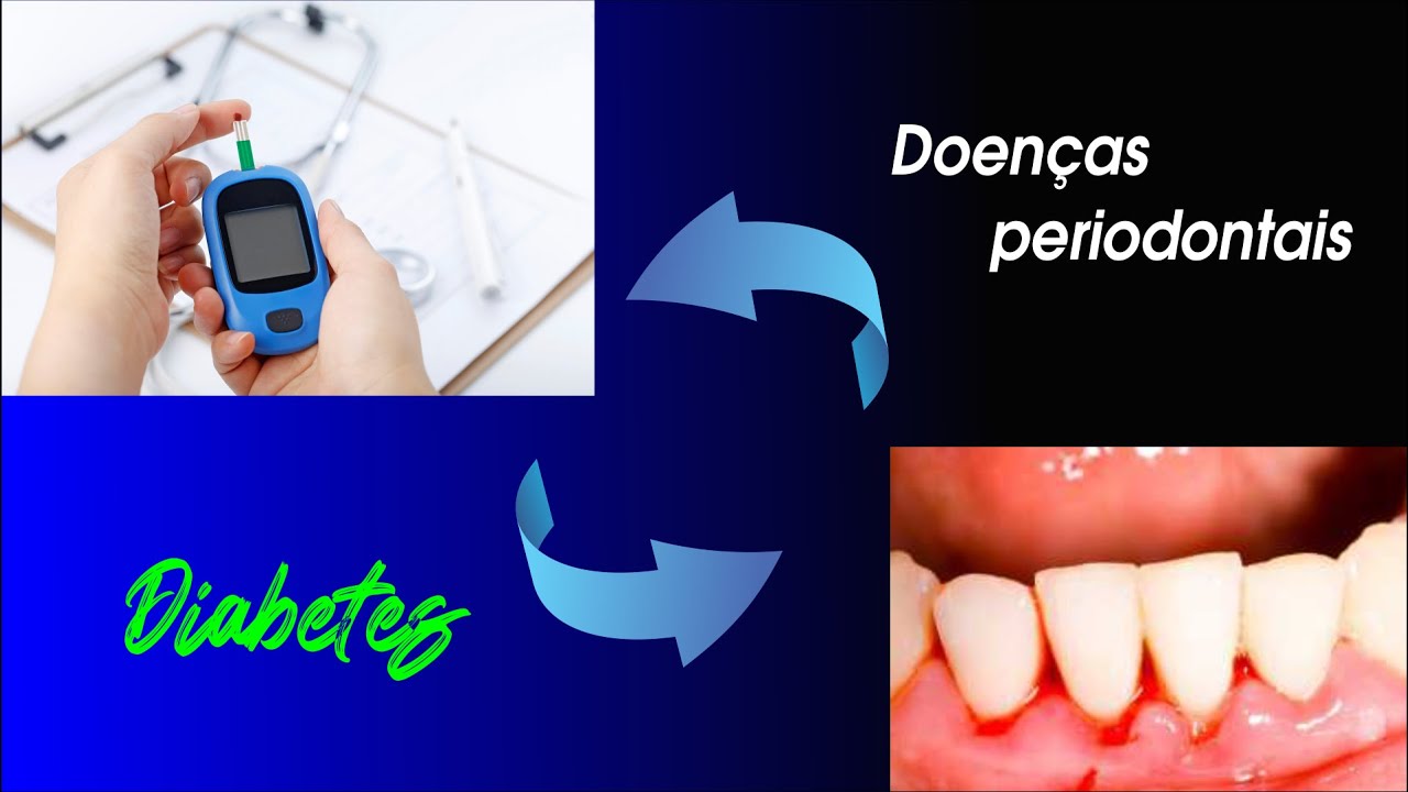 Existe relação entre as Doenças Periodontais e o Diabetes?