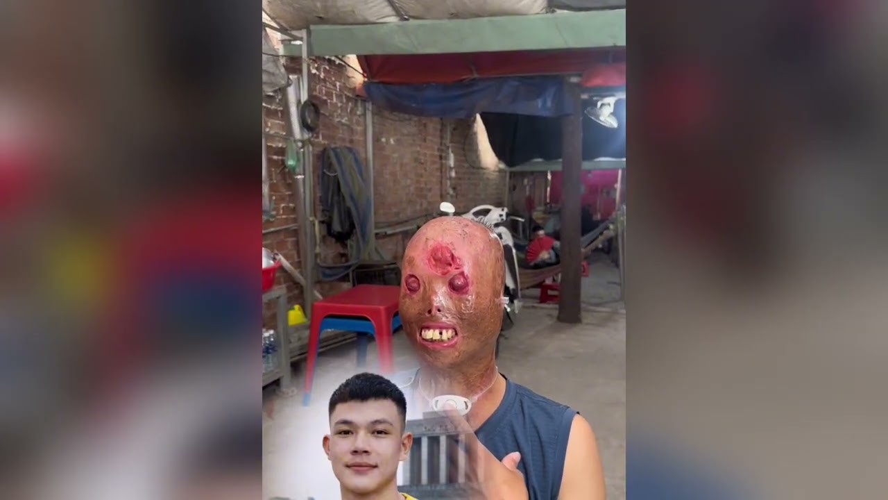 Chàng Trai 31 Tuổi Và Hành Trình Đi Tìm Lại Gương Mặt Của Mình——-#tranmanhnghiatinh