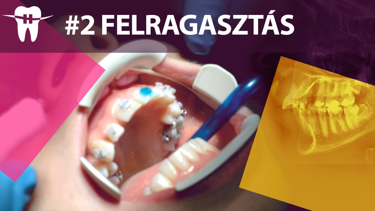 #2 Rögzített fogszabályzó felragasztása VIDEÓVAL - Fogszabályozás 30 felett
