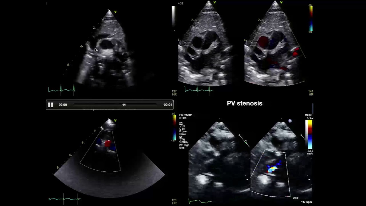 Echocardiography in Congenital Heart Disease