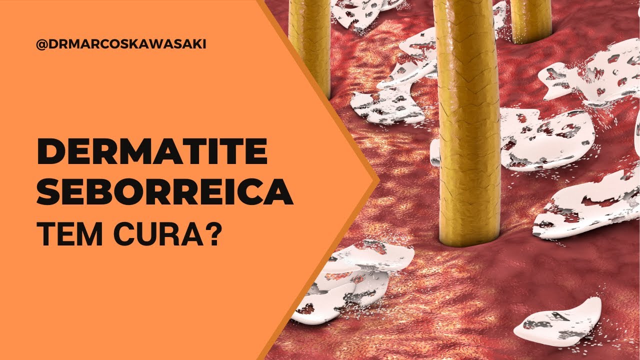 Dermatite seborreica tem cura?