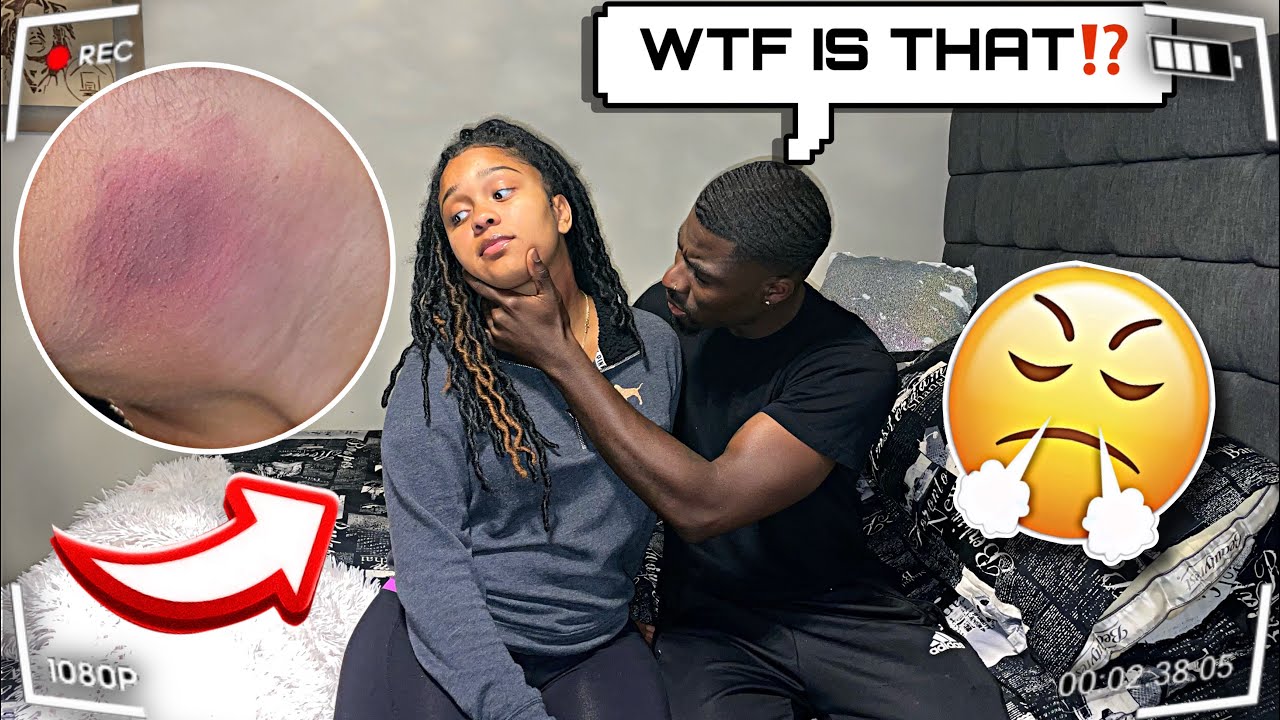 HICKEY PRANK ON MY BOYFRIEND! *BIG MISTAKE*