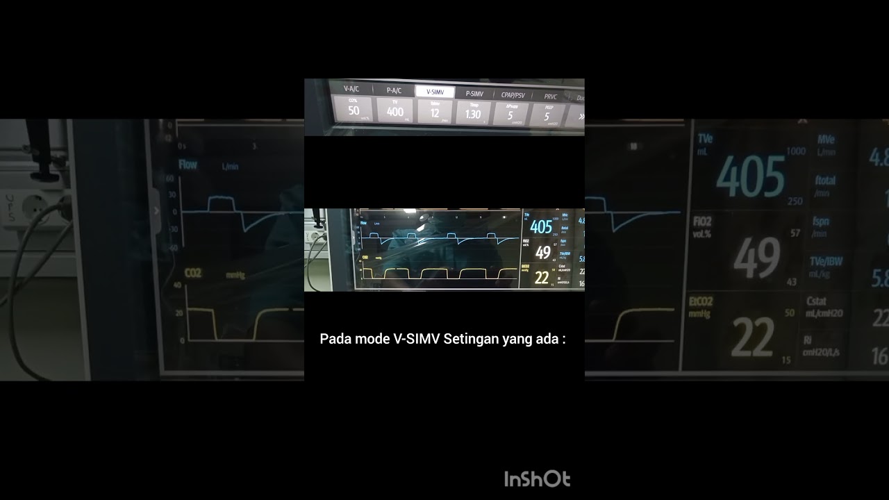 Ventilator mindray dengan mode V-SIMV 