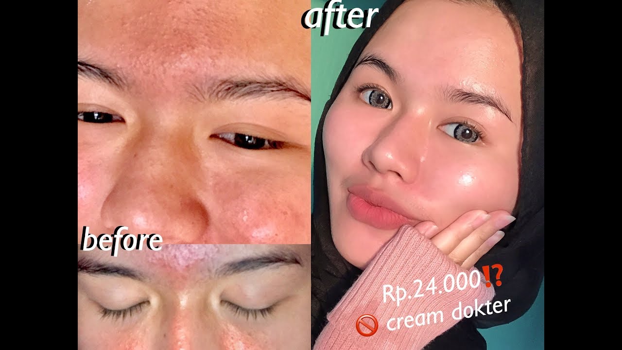BRUNTUSAN? HILANG SEMALAM AJA! 😳 [ #Pengalamanku sharing & SkinCare Updated Nabilrach ]