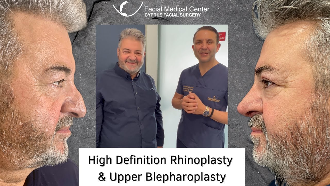 High Definition Rhinoplasty & Upper Blepharoplasty |Cyprus Facial Surgery