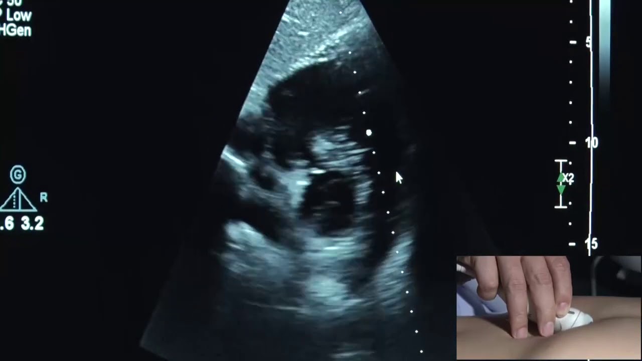 Trình diễn siêu âm đánh giá thất phải (Demo: Echocardiographic Assessment of the right ventricle)