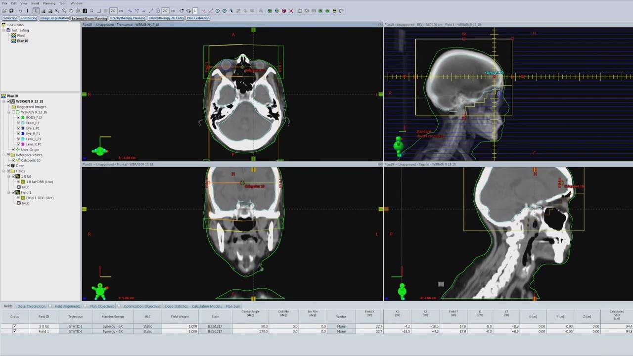3DCRT Whole Brain Radiation Planning