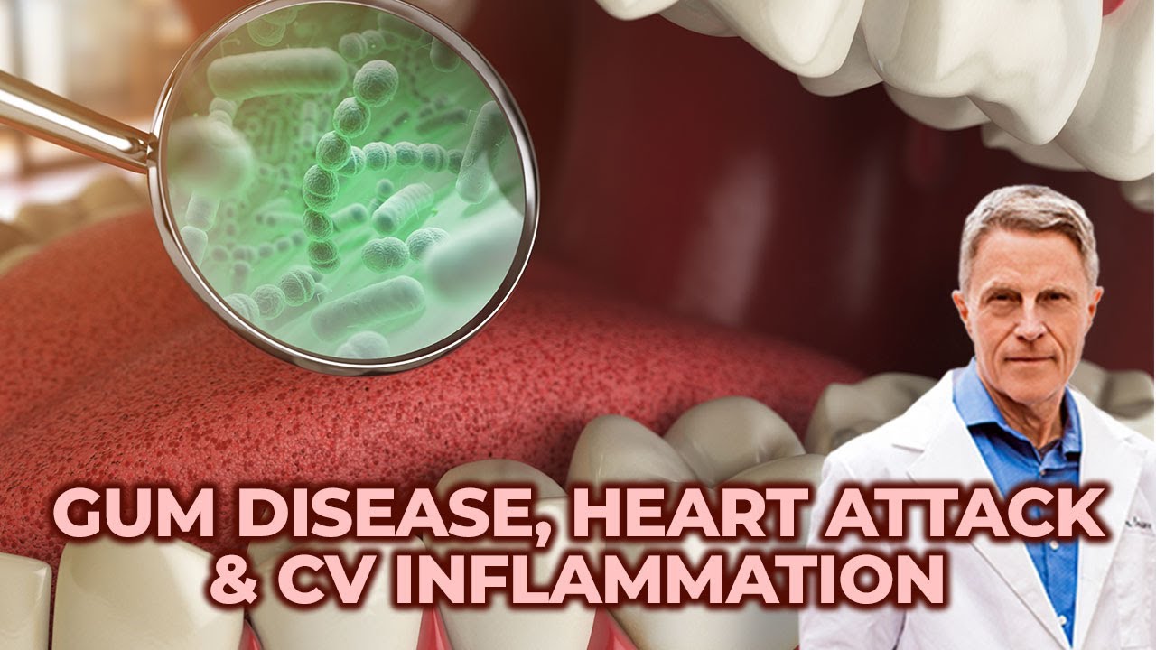 Gum Disease, Heart Attack & CV  Inflammation 2019 -Doug Thompson DDS & Ford Brewer MD