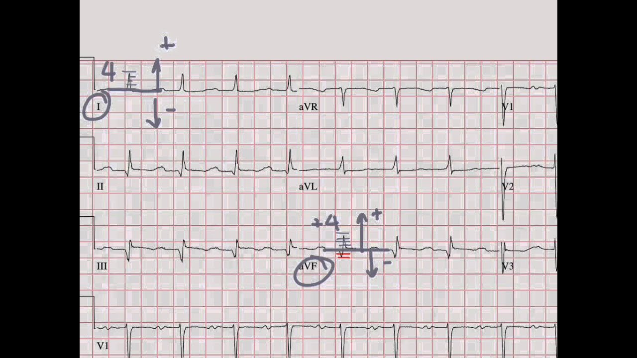EKG 05: Axis (2012)
