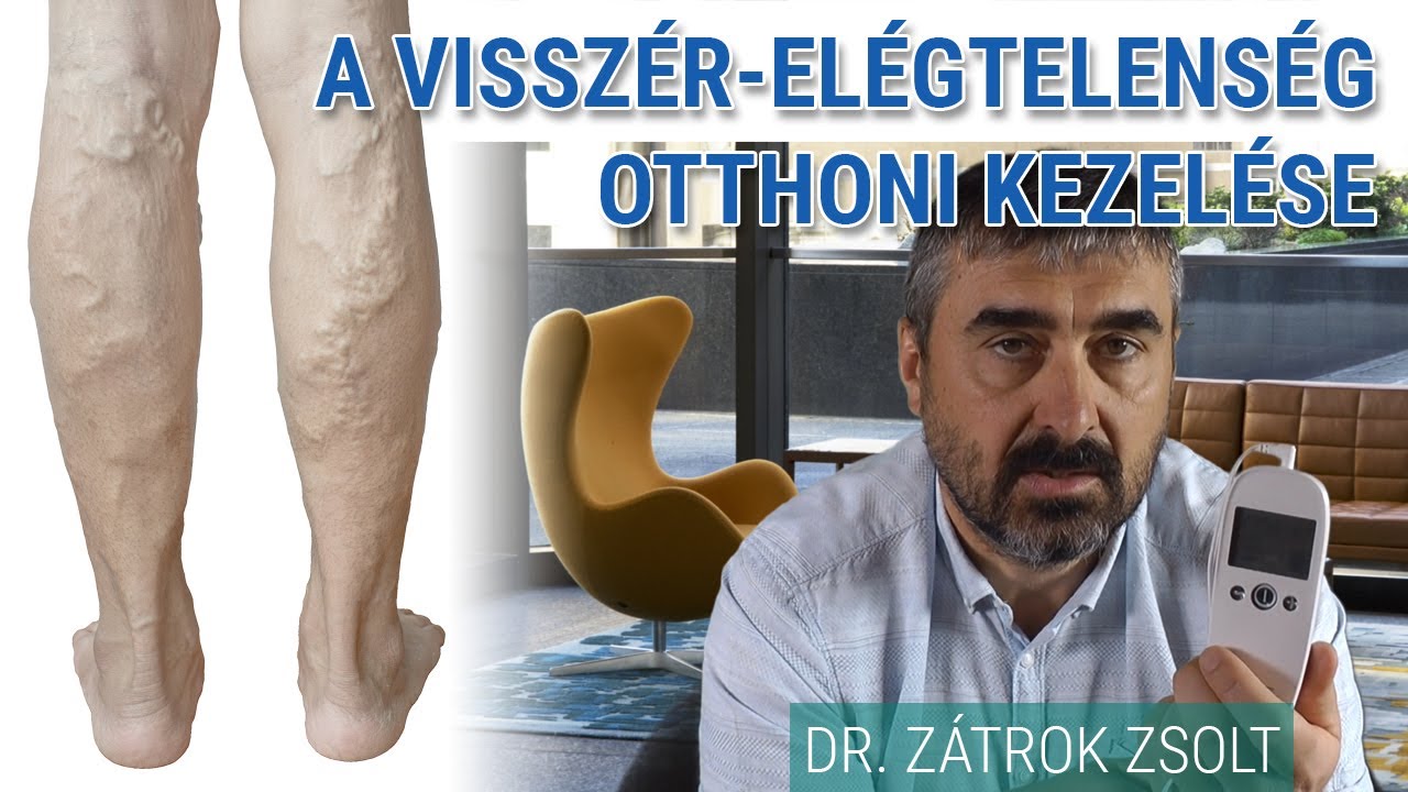 Visszér-elégtelenség otthoni kezelési lehetőségei