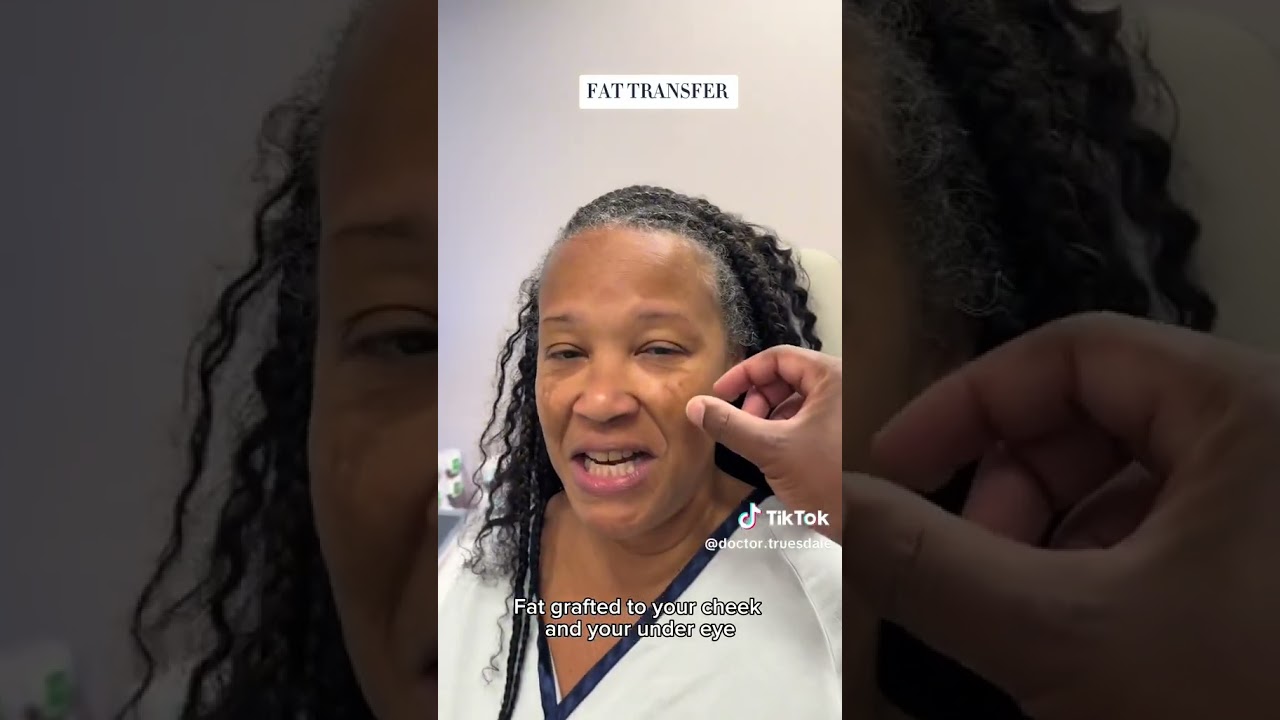 Check out this AMAZING facelift result ONE DAY after surgery!