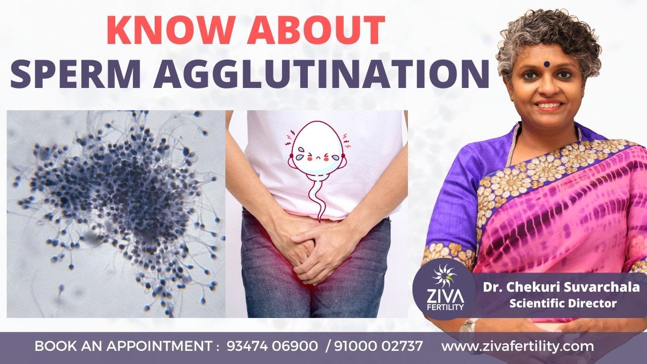 Sperm Agglutination | Causes And Treatment | Male Infertility | Dr C Suvarchalaa | ZIVA Fertilityy