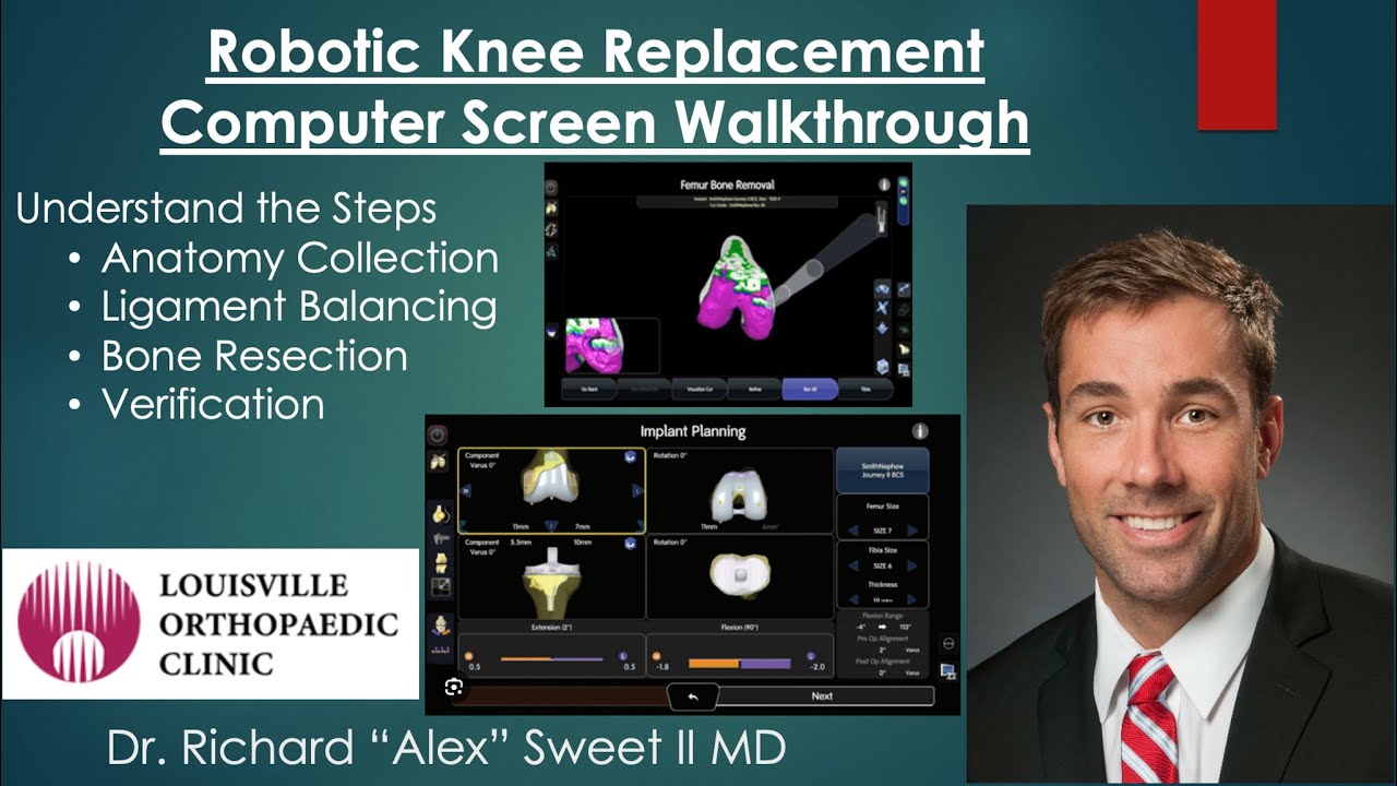 CORI Robotic Total Knee Computer Screen Walkthrough