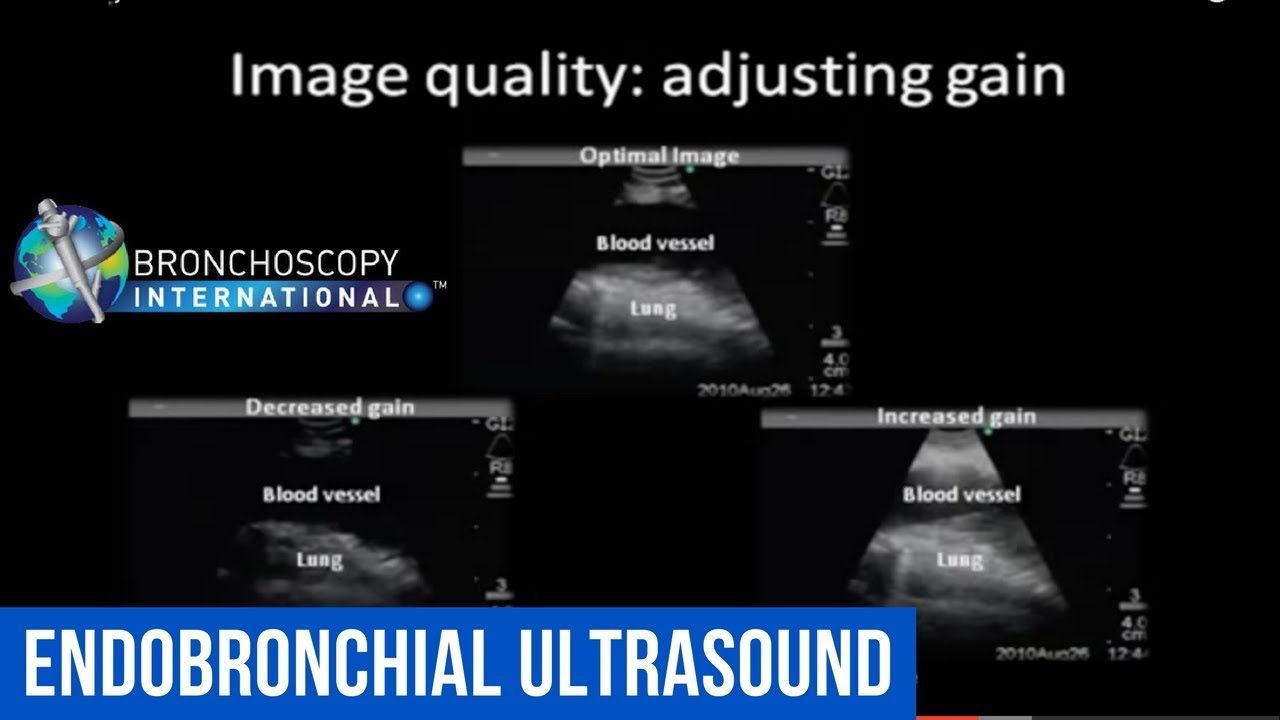 EBUS Physics Video - Endobronchial Ultrasound