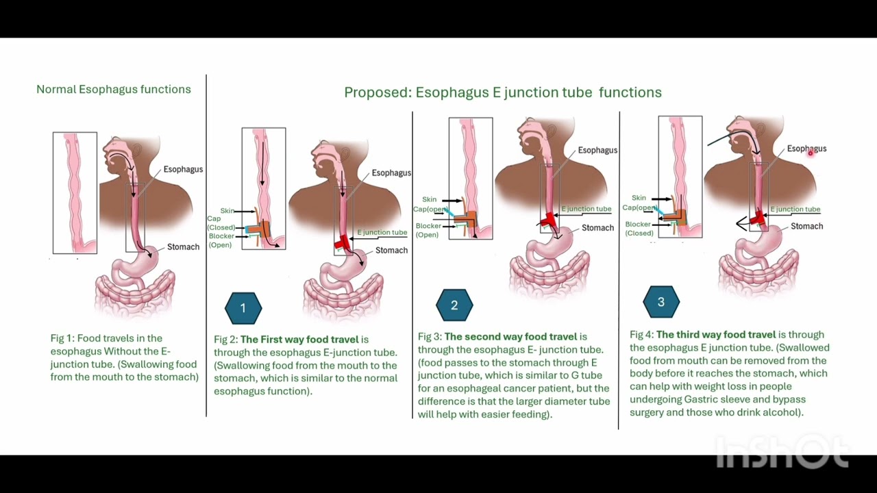 EJunction tube short description (feeding and expulsion of food and an additional airway to lungs).