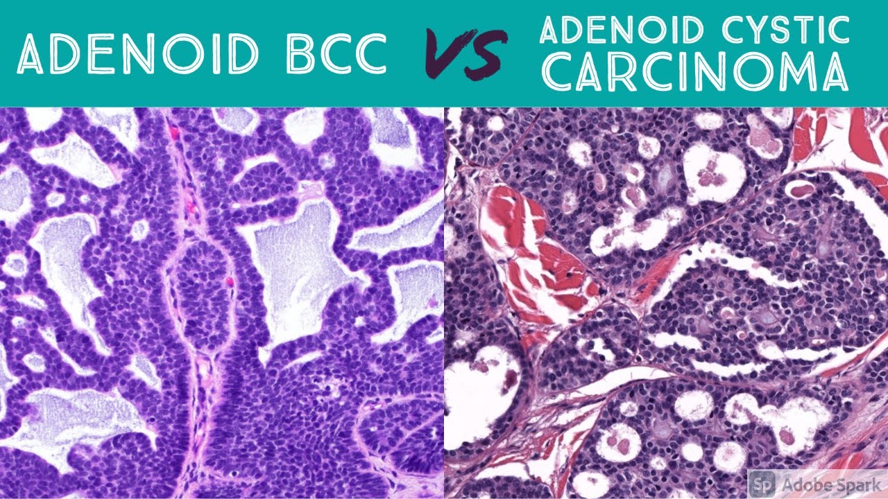 Cutaneous Adenoid Cystic Carcinoma vs Adenoid Basal Cell Carcinoma (Dermpath Dermatology Pathology)