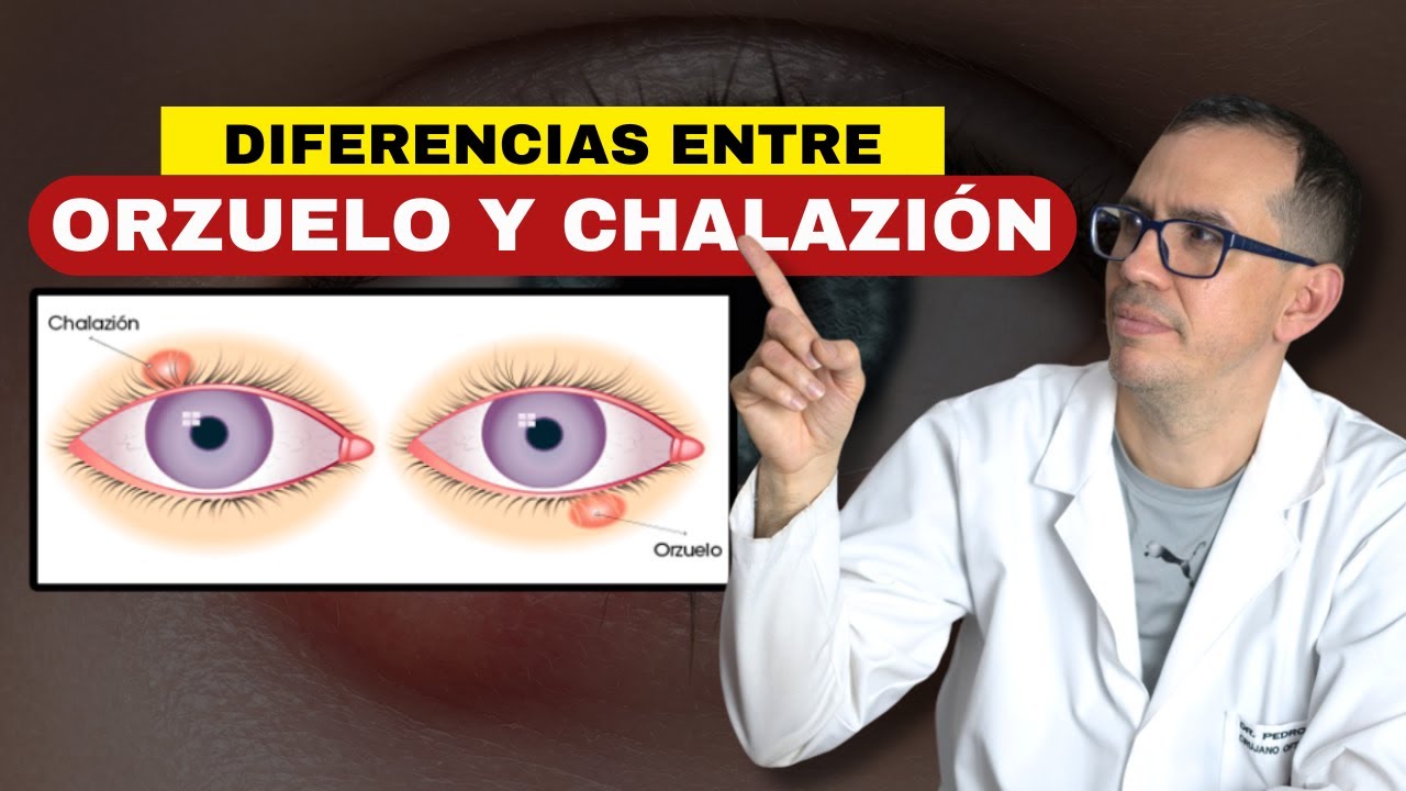 MÉDICO OFTALMÓLOGO EXPLICA DIFERENCIAS ENTRE ORZUELO Y CHALAZIÓN / Doctor Ojo 🥼🩺👁