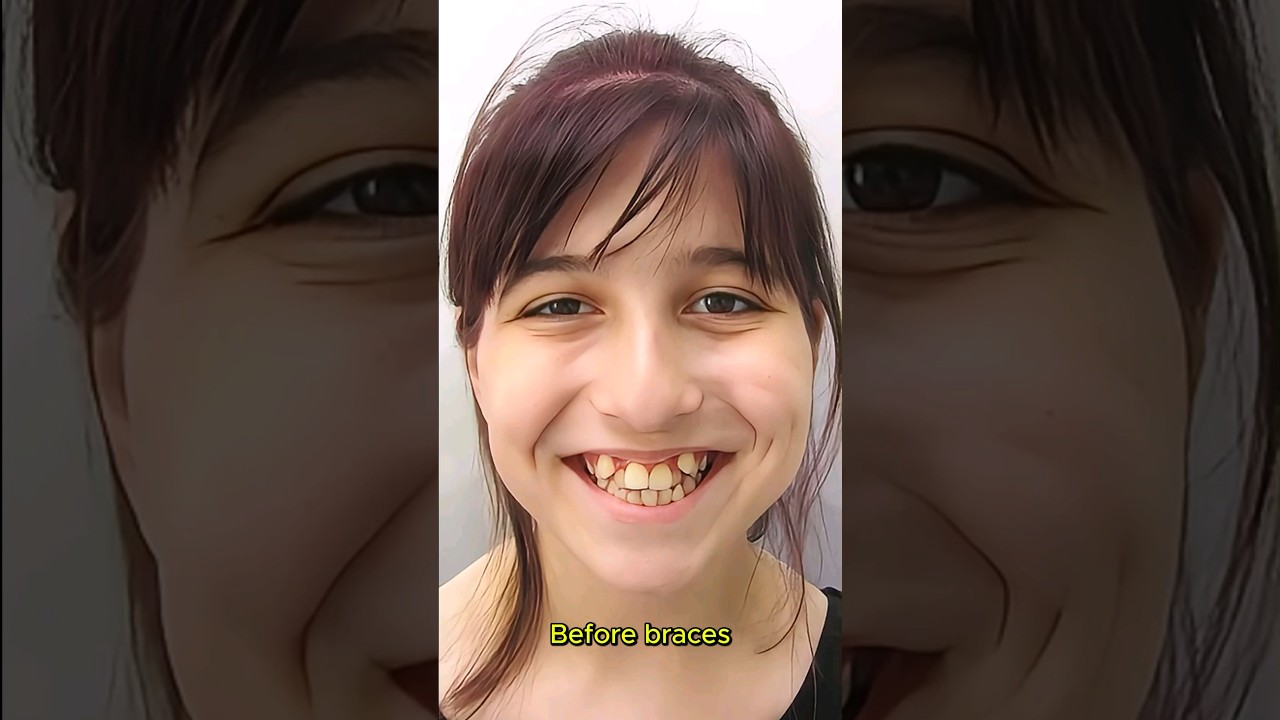 Change smile with braces #braces #orthodontist #dentist