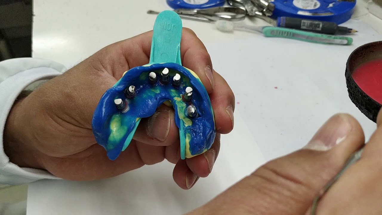 Análise moldagem, colocação dos análogos e confecção de gengiva artificial para protocolo superior