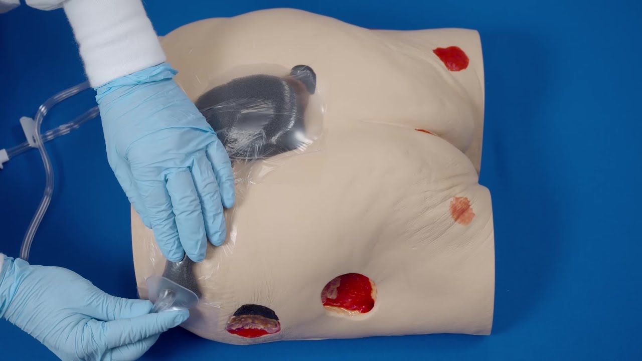 Bridging to Offload FitPad - Medela Invia&reg; Foam Dressing Application