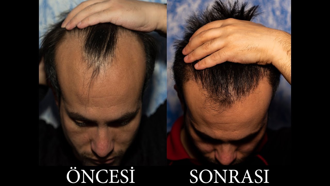 Sa&ccedil; Ekimi ilk 6 ay