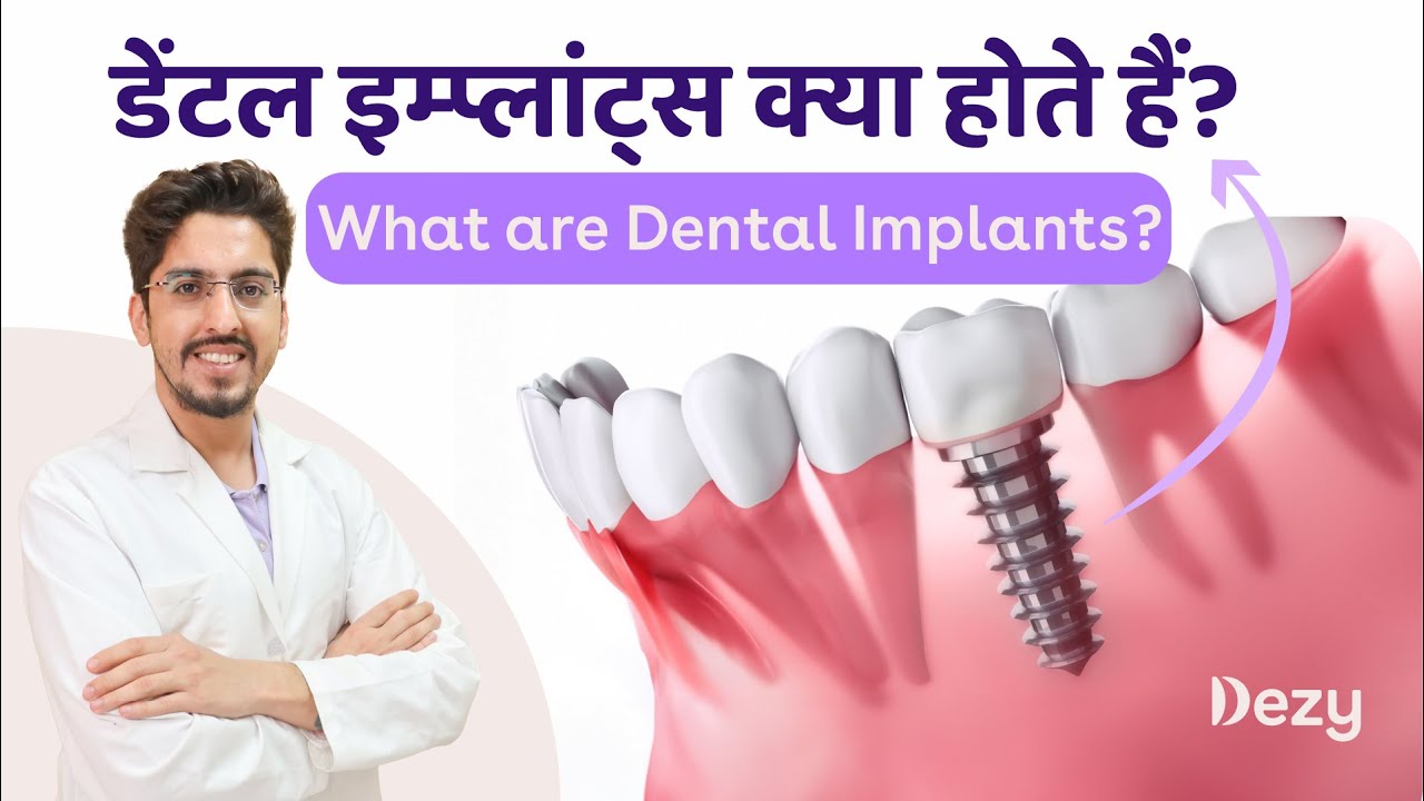 What are Dental Implants? Explained in Hindi by Dezy Dentist