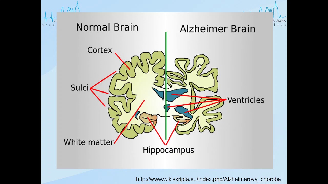 Alzheimerova choroba