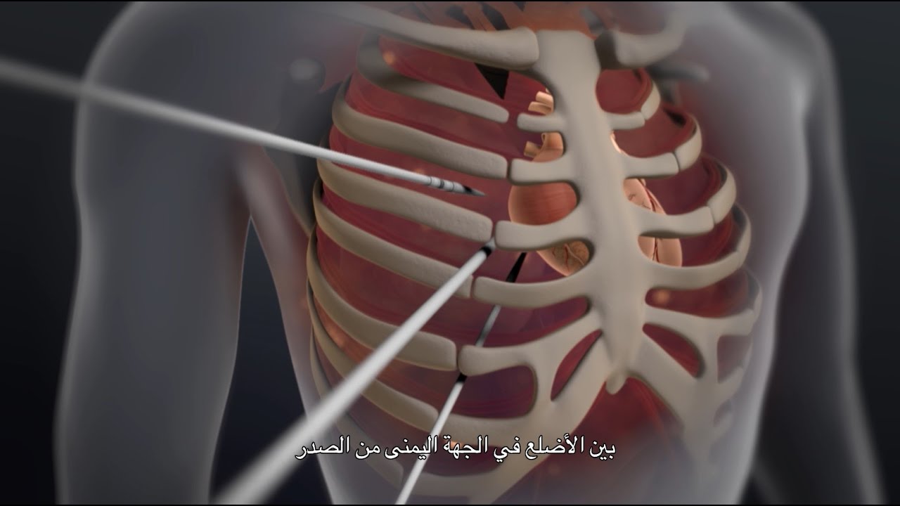 إصلاح الصمام بتقنية الحد الأدنى من التدخل الجراحي