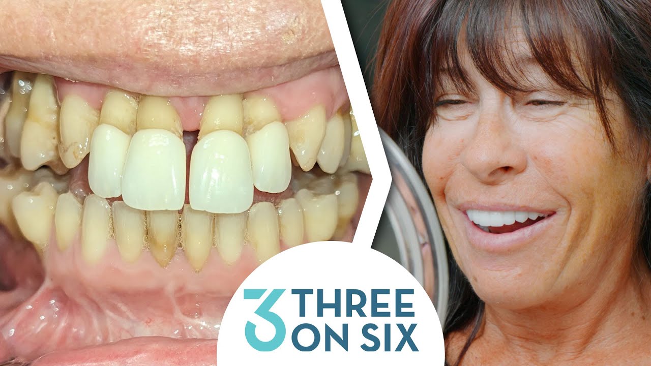Affordable Dental Implants and Bridges with 3 on 6
