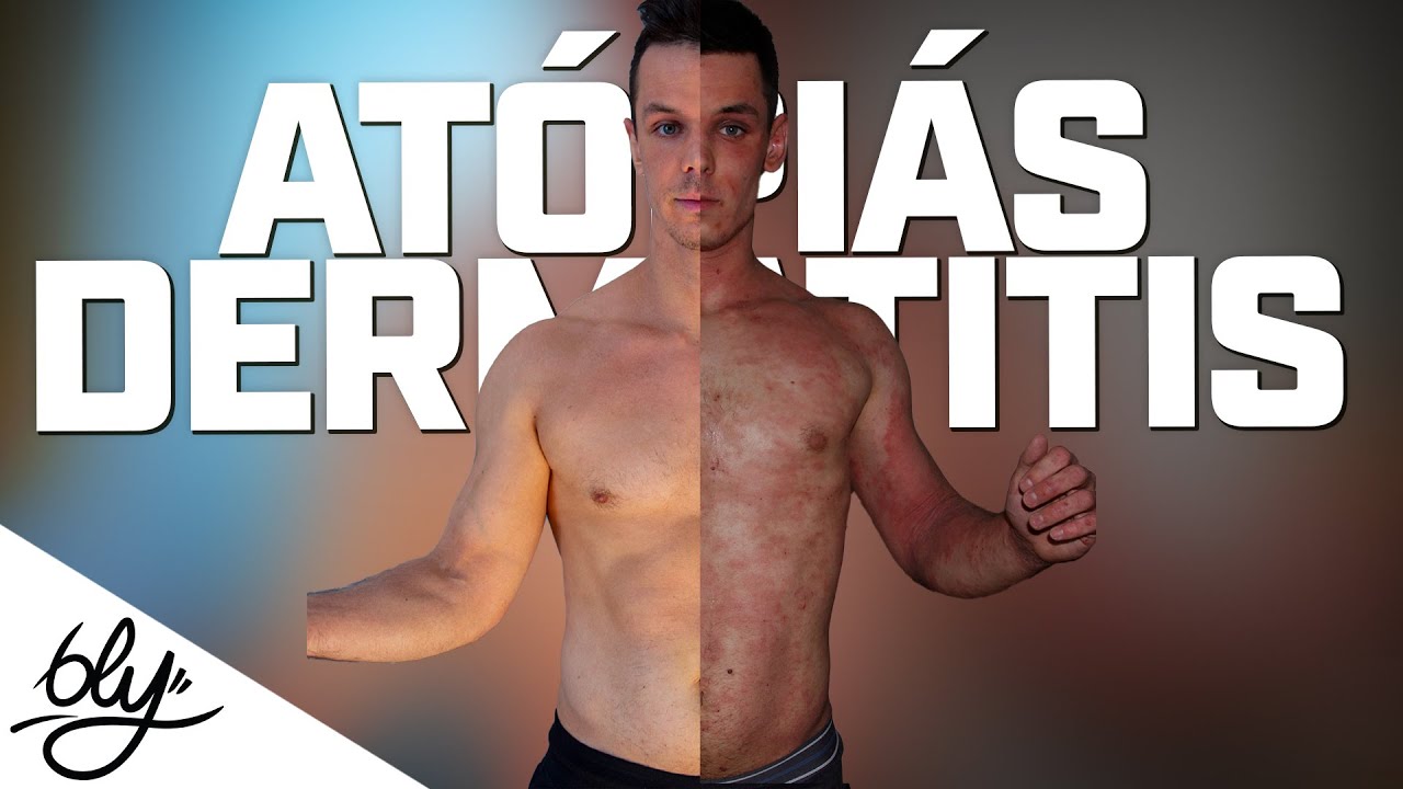 🔴 ATÓPIÁS DERMATITIS ÉS A TÖRTÉNETEM 🔴 +EXTRA VÁLASZOK TŐLETEK