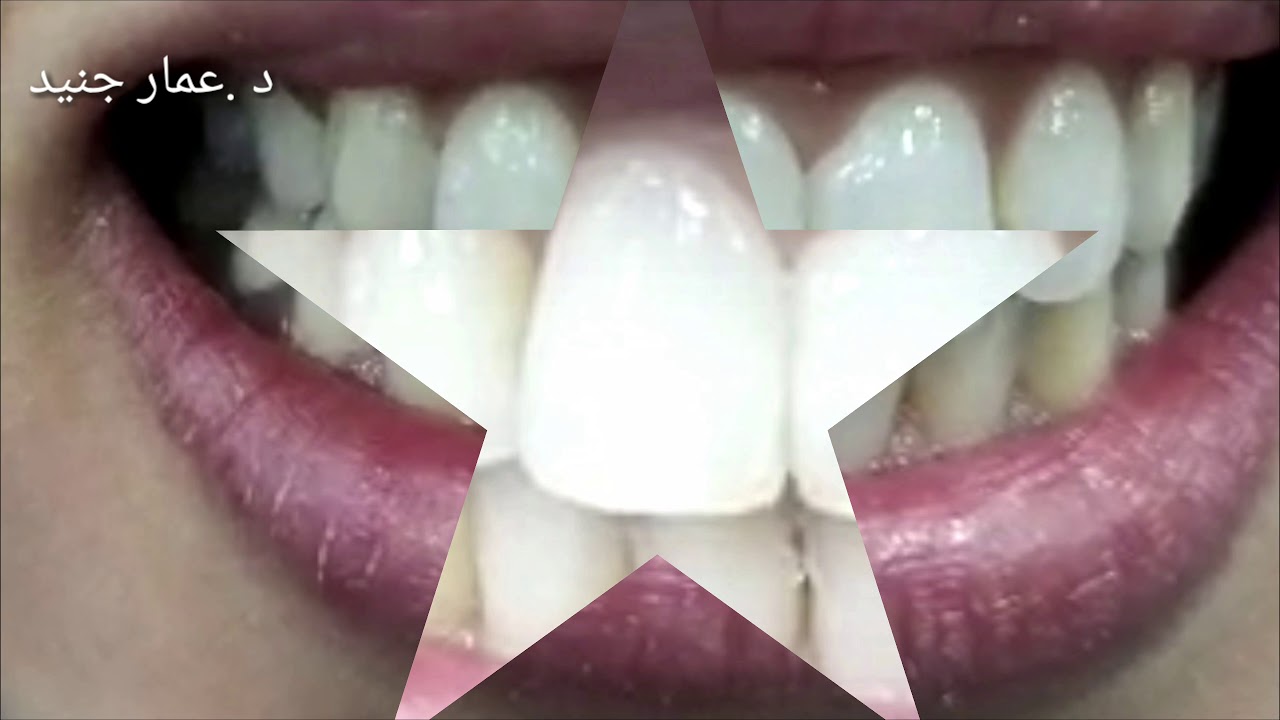 تعديل بسيط وابتسامة أجمل