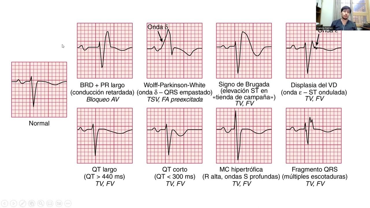 Cardiologia: Diagnóstico y manejo de TAQUICARDIA VENTRICULAR