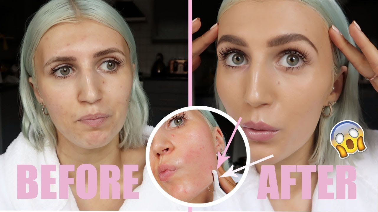 AT HOME DERMAPLANING SKIN TREATMENT (FOR GLOWY SKIN + REDUCING ACNE SCARS)