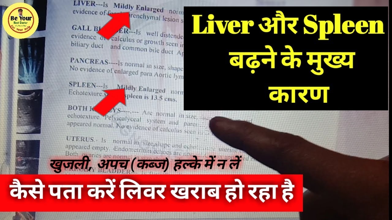 Hepatospleenomegaly Ultrasounds Report and Cause In Hindi